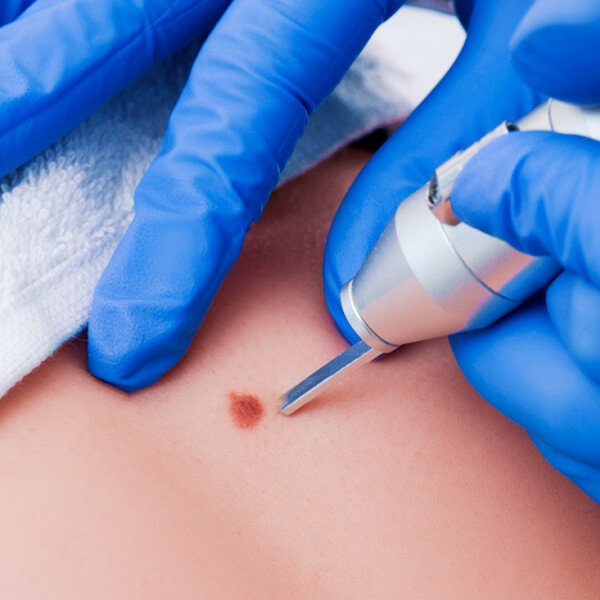 Por-que-se-realizan-cirugías-dermatológicas