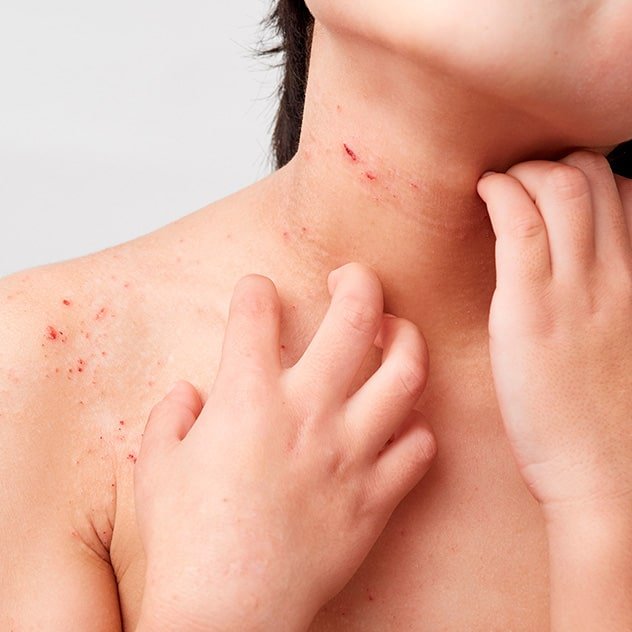 Dermatitis atópica ​