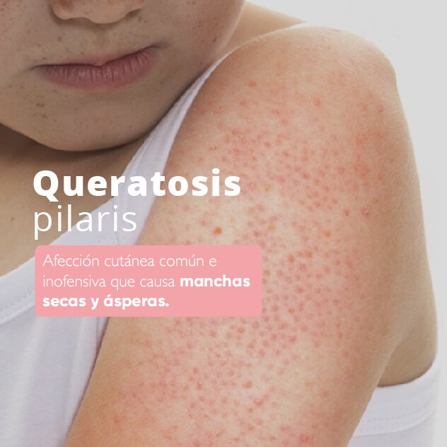 queratosis-pilaris