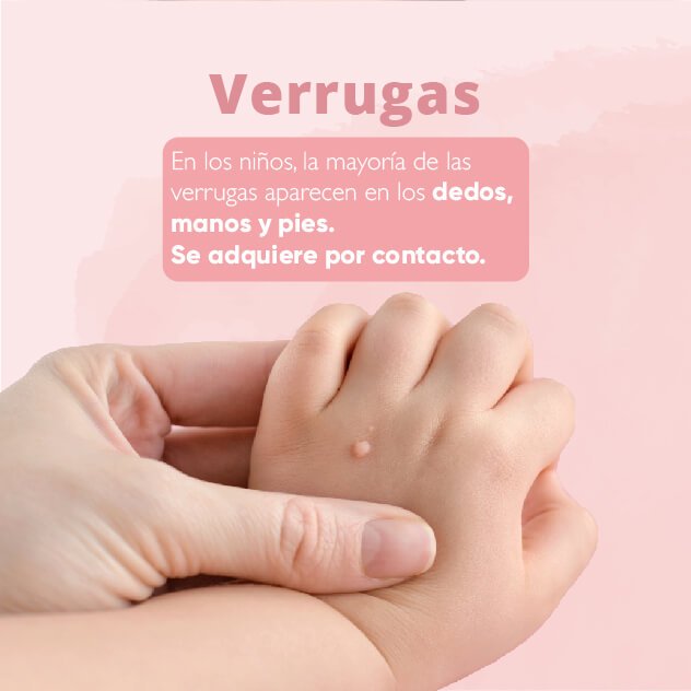 verrugas