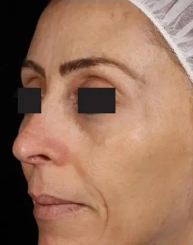 después de elos laser