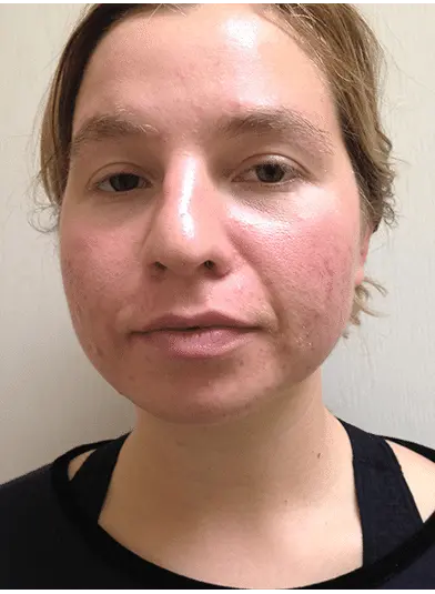 después de lumifacial