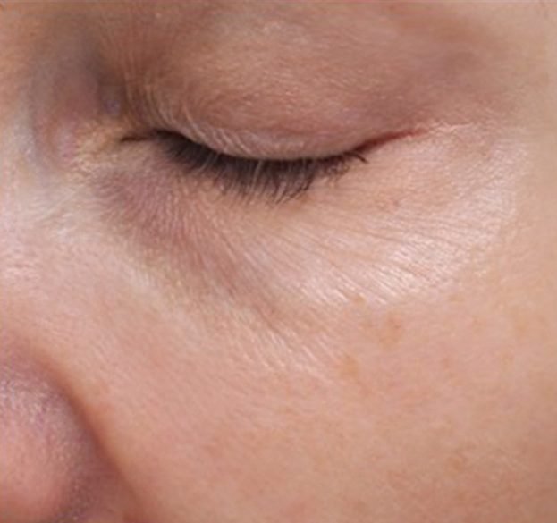 fillmed-NCTF-eyes-after