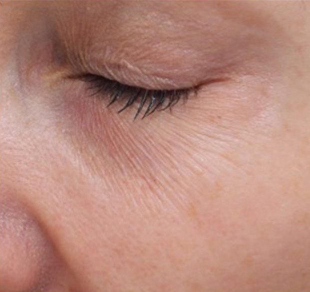 fillmed-NCTF-eyes-before-1