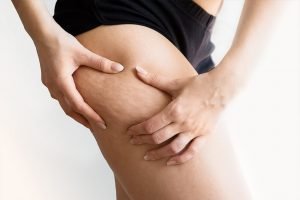 Mujer de perfil luce piel sin celulitis gracias a tratamiento anticelulítico