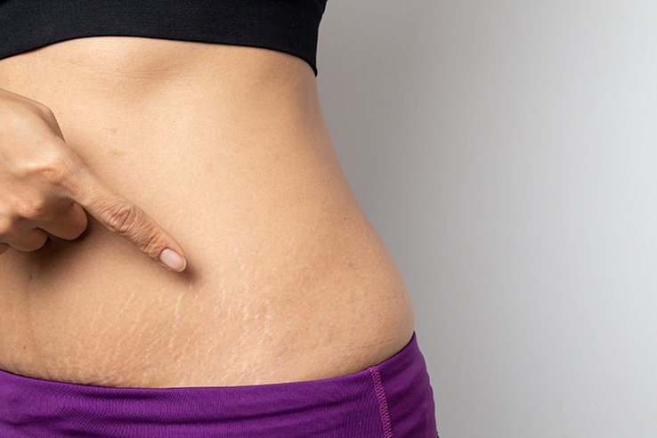 Mujer con atuendo deportivo señala sus estrías en el abdomen