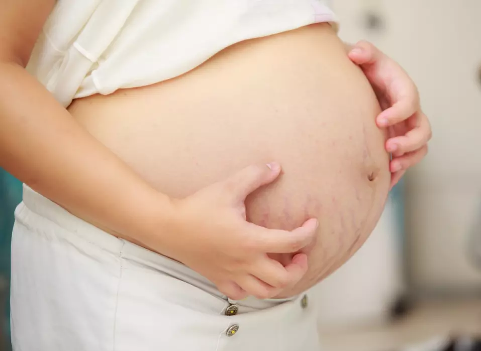 Detalle de abdomen de mujer embarazada con estrías,  previo a la erupción de puppp