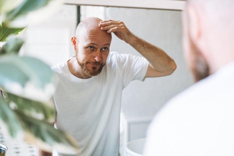 Close up de hombre con alopecia con sus manos en la cabeza