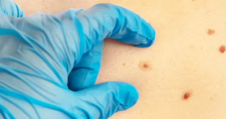 Día Mundial del Cáncer de Piel. ¿Cuándo fue la última vez que revisaste tus lunares?